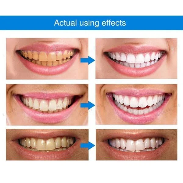 🔥Hot Sale🔥 TEETH WHITENING PENS